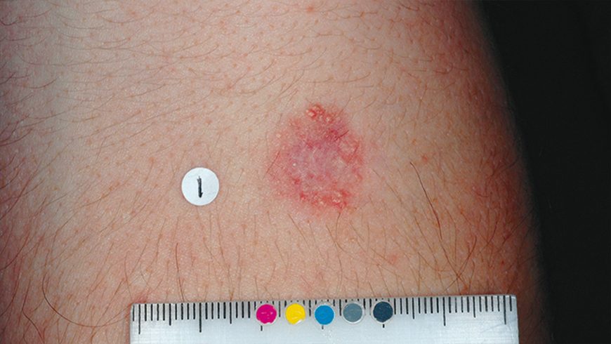 Basal cell carcinoma lesion on arm after 24 weeks of treatment with Erivedge