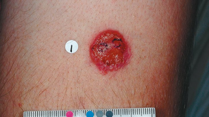 Advanced basal cell carcinoma lesion on lateral temple