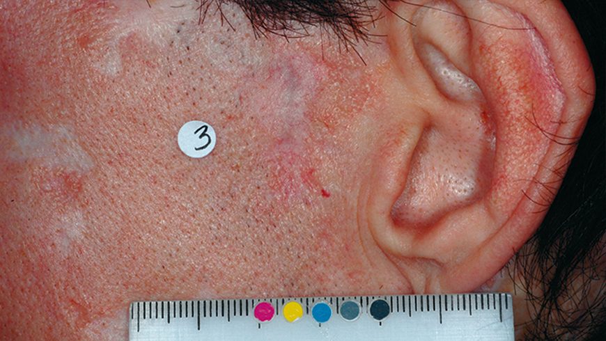 Basal cell carcinoma lesion on temple after 24 weeks of treatment with Erivedge