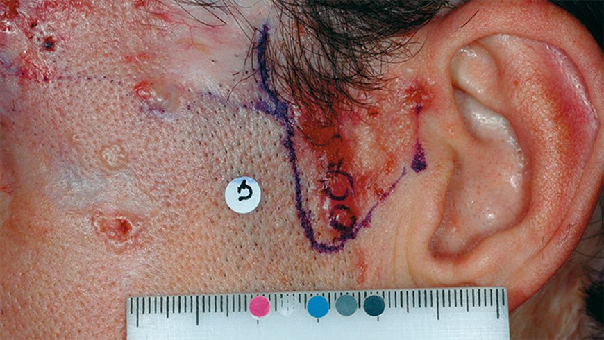 Baseline basal cell carcinoma lesion on temple of patient treated with Erivedge