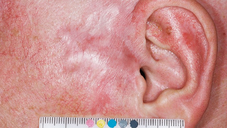 Basal cell carcinoma lesion on preauricular area after 24 weeks of treatment with Erivedge