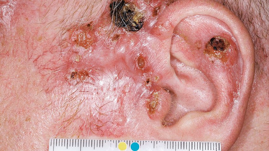 Baseline basal cell carcinoma lesion on preauricular area of patient treated with Erivedge