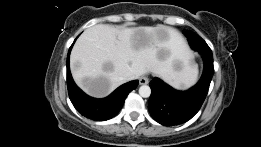 X-ray of baseline basal cell carcinoma lesion on liver of patient treated with Erivedge