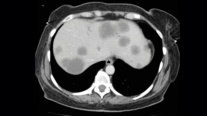 X-Ray image of metastatic basal cell carcinoma on the liver