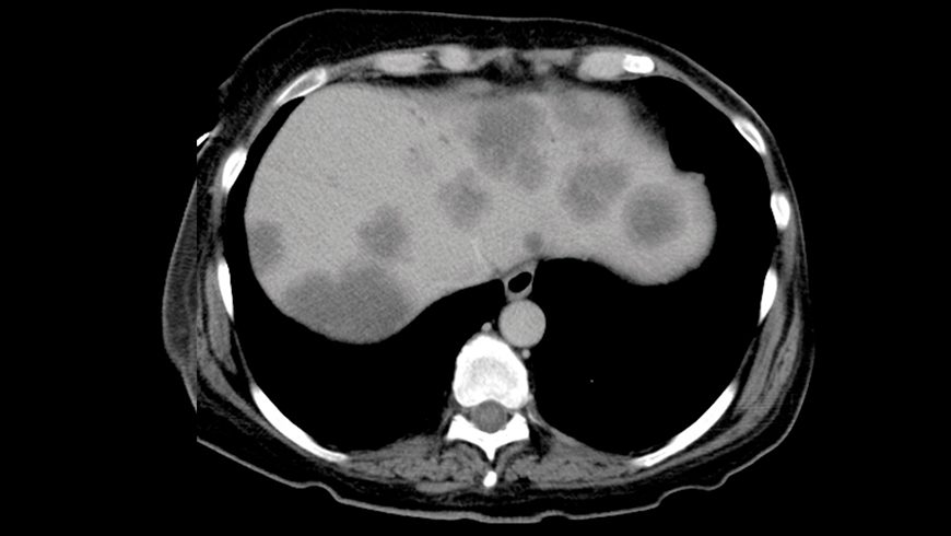 X-ray of basal cell carcinoma lesion on liver after 8 weeks of treatment with Erivedge