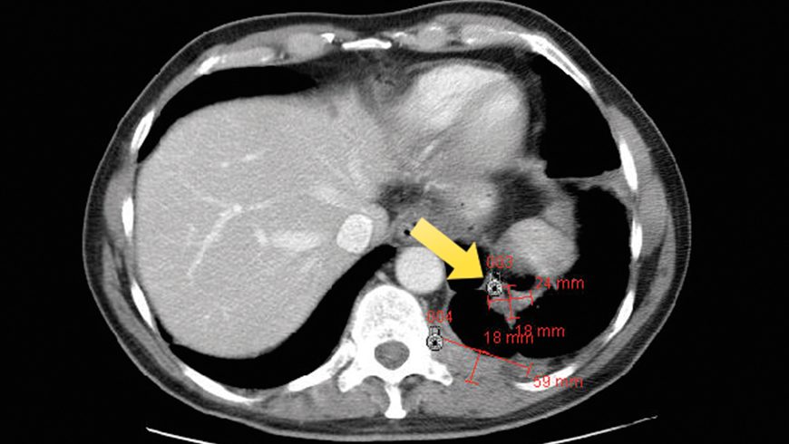 X-ray of basal cell carcinoma lesion on lung after 24 weeks of treatment with Erivedge