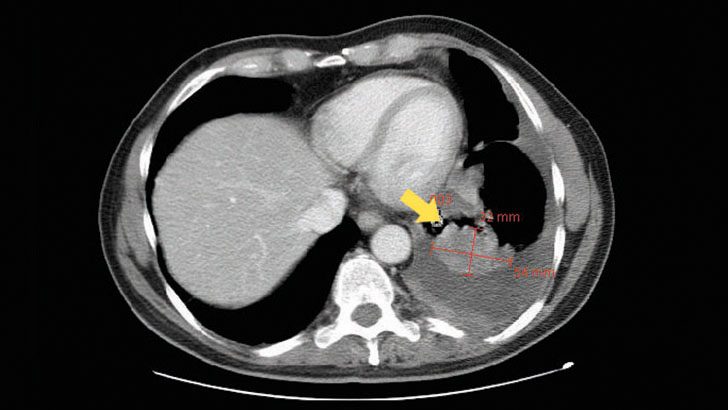 X-Ray image of large metastatic basal cell carcinoma on lung