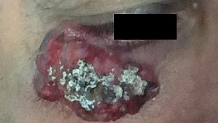 Baseline basal cell carcinoma lesion on malar cheek of patient treated with Erivedge