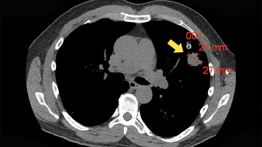 X-ray of baseline basal cell carcinoma lesion on lung of patient treated with Erivedge