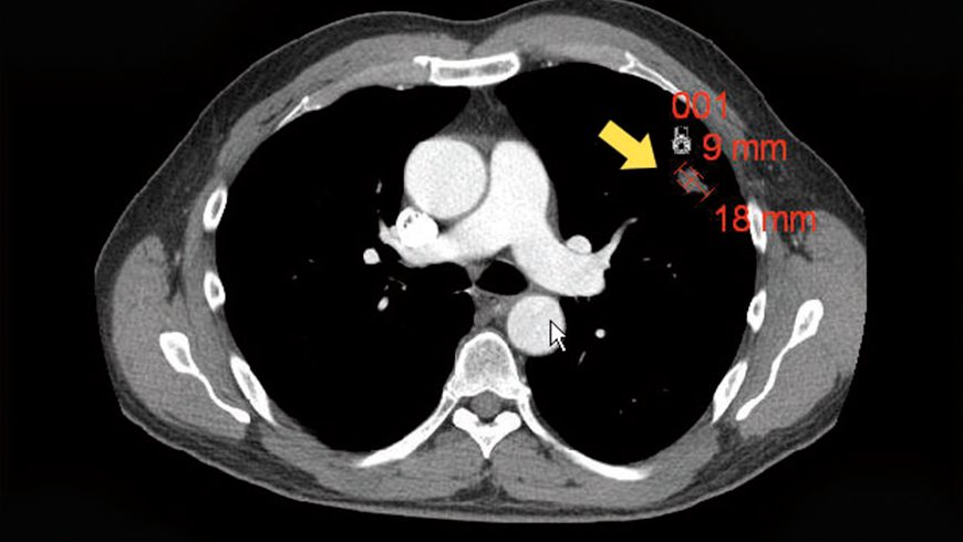 X-ray of basal cell carcinoma lesion on lung after 24 weeks of treatment with Erivedge