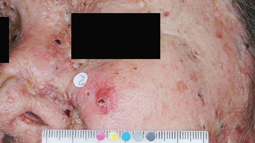 Baseline basal cell carcinoma lesion on cheek of patient treated with Erivedge