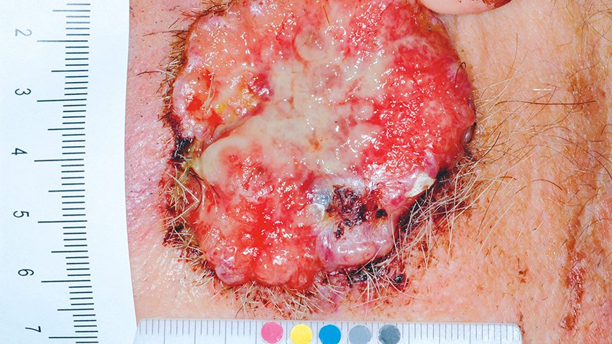 Baseline basal cell carcinoma lesion on cheek of patient treated with Erivedge