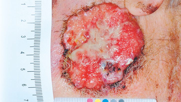 Advanced basal cell carcinoma lesion with measuring tape on patient cheek