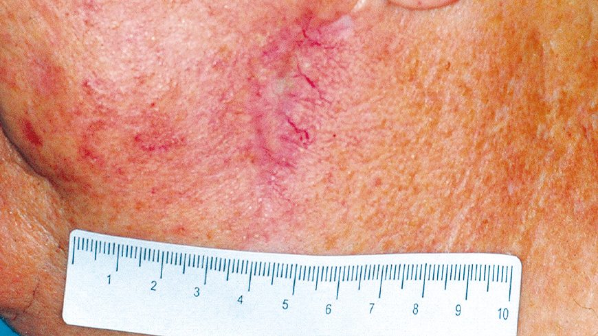 Basal cell carcinoma lesion on cheek after 24 weeks of treatment with Erivedge