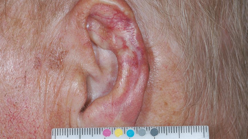 Basal cell carcinoma lesion on ear after 24 weeks of treatment with Erivedge