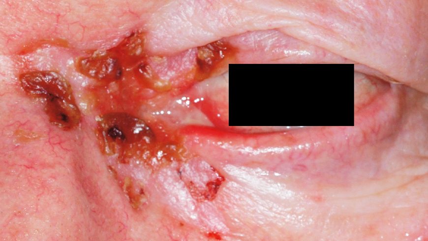 Basal cell carcinoma lesion on eye after 24 weeks of treatment with Erivedge