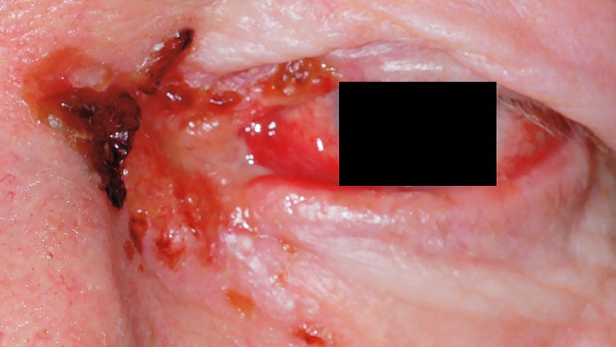 Baseline basal cell carcinoma lesion on eye of patient treated with Erivedge