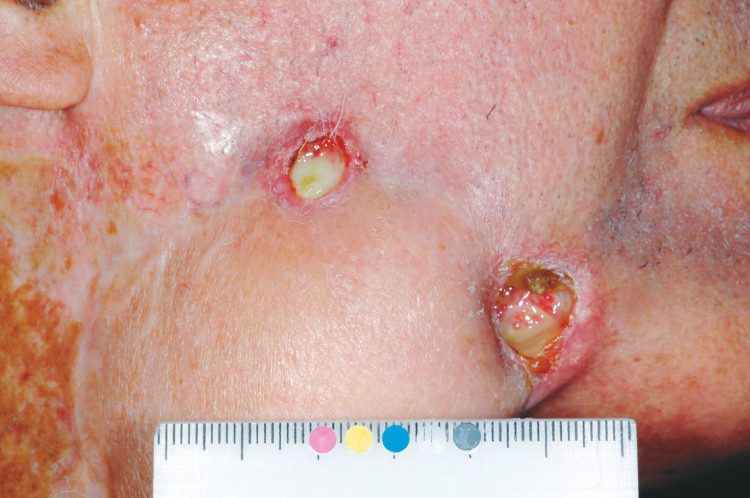 Locally invasive advanced basal cell carcinoma lesion on patient cheek