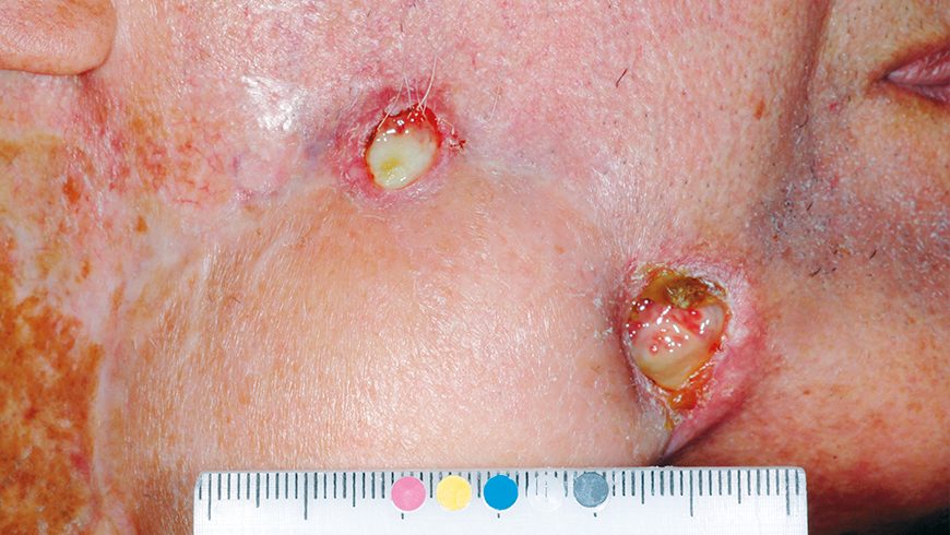 Baseline basal cell carcinoma lesion on neck of patient treated with Erivedge