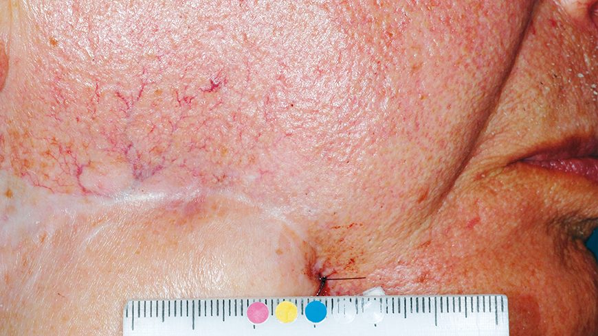 Basal cell carcinoma lesion on neck after 24 weeks of treatment with Erivedge