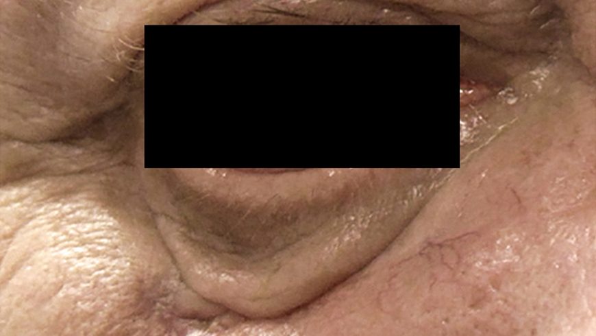 Basal cell carcinoma lesion on eye after 36 weeks of treatment with Erivedge