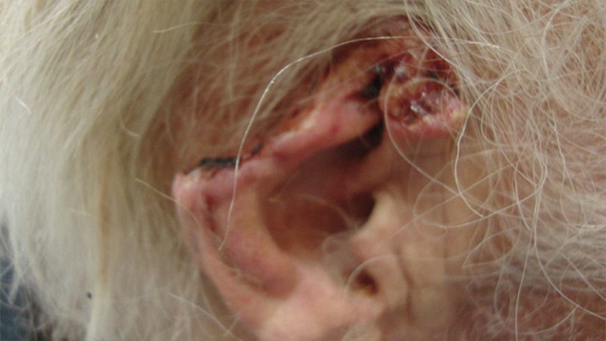 Baseline basal cell carcinoma lesion on ear of patient treated with Erivedge