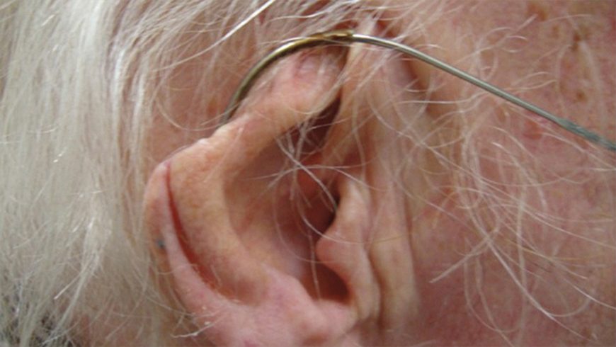 Basal cell carcinoma lesion on ear after 9 months of treatment with Erivedge