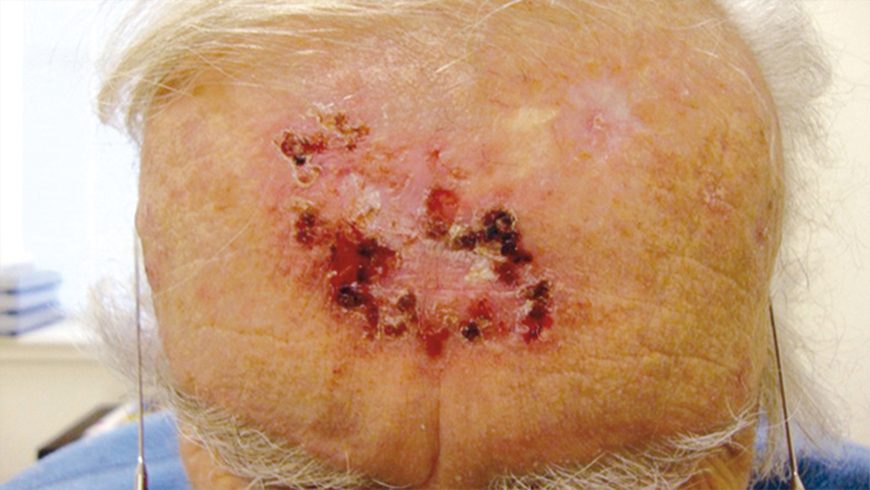 Baseline basal cell carcinoma lesion on forehead of patient treated with Erivedge