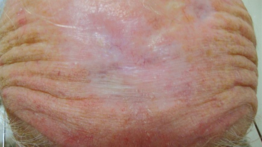 Basal cell carcinoma lesion on forehead after 9 months of treatment with Erivedge