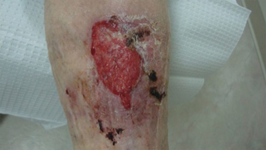 Baseline basal cell carcinoma lesion on shin of patient treated with Erivedge