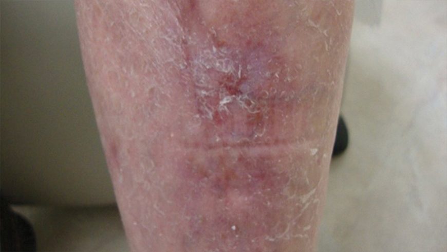 Basal cell carcinoma lesion on shin after 9 months of treatment with Erivedge